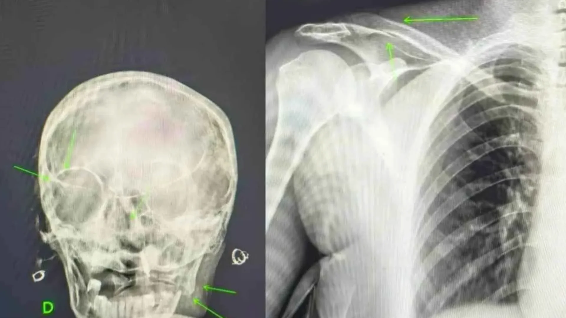 Raio-X mostra graves lesões sofridas pela mãe.