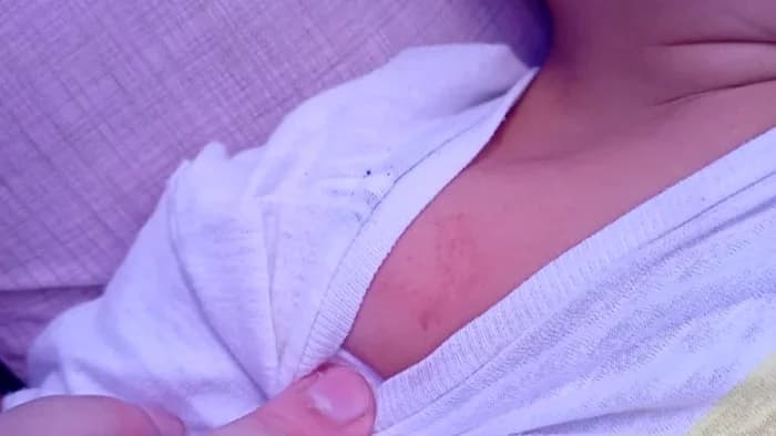 Hematomas da Criança