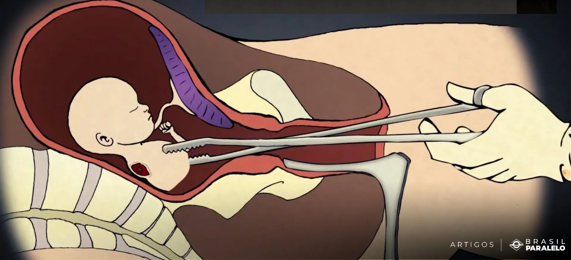 Como é feito o aborto