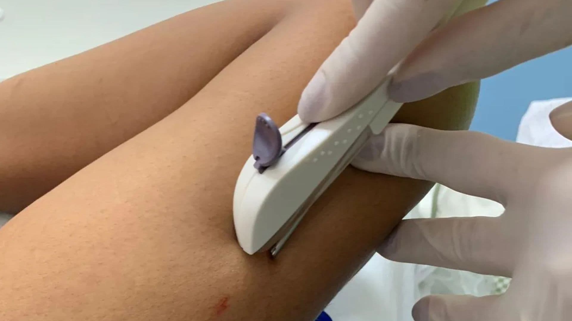 preservativo subcutâneo, equipamento está sendo colocado em crianças de 10 anos pela prefeitura de Fortaleza.